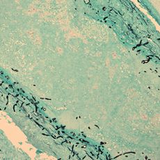 New England Compounding Center meningitis outbreak