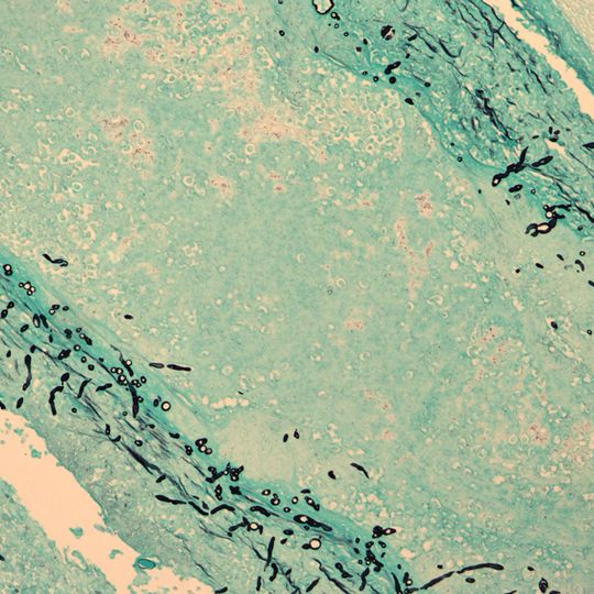 New England Compounding Center meningitis outbreak